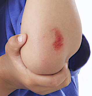 Yaraları daha hızlı ve etkili iyileştiren 9 besin