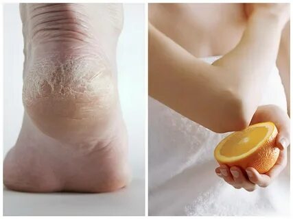 Foto - Yarım limonu topuğunuza sürüp bekleyin! Gördüğünüz etkiye inanamayacaksınız