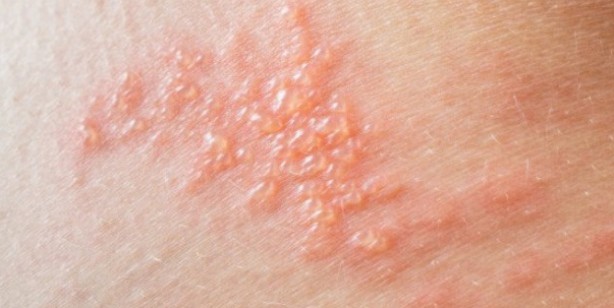 Foto - Yaz ayları gelirken dikkat! Güneş alerjisini gösteren 6 belirti