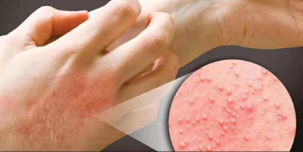 Yaz ayları gelirken dikkat! Güneş alerjisini gösteren 6 belirti