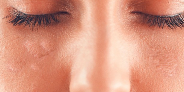 Foto - Yaz ayları gelirken dikkat! Güneş alerjisini gösteren 6 belirti