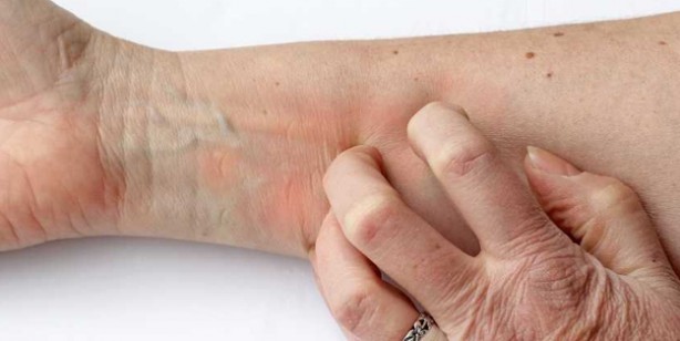 Foto - Yaz ayları gelirken dikkat! Güneş alerjisini gösteren 6 belirti