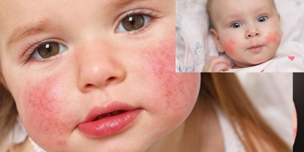 Foto - Yaz ayları gelirken dikkat! Güneş alerjisini gösteren 6 belirti