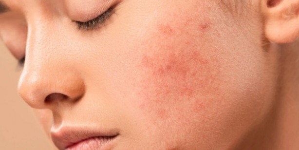 Foto - Yaz ayları gelirken dikkat! Güneş alerjisini gösteren 6 belirti