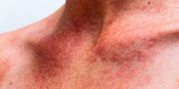 Foto - Yaz ayları gelirken dikkat! Güneş alerjisini gösteren 6 belirti