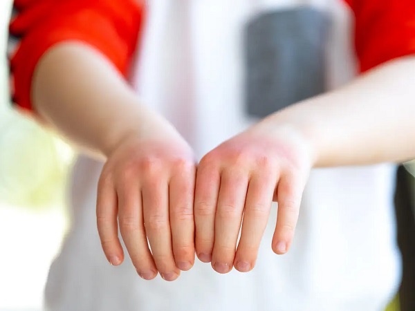 Foto - Yaz mevsimi zehir olmasın! Çocuklarınızın sağlığı için bu hataları yapmayın