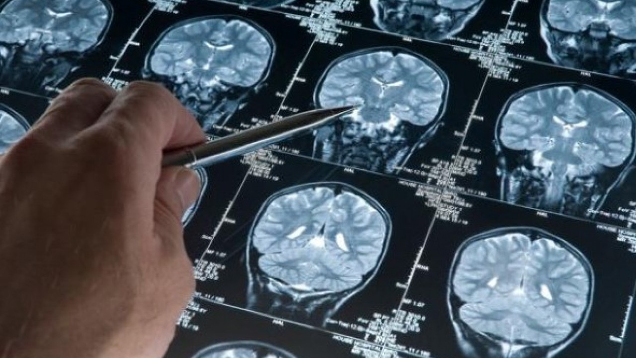 Foto - Yeni bir araştırmayla ortaya çıktı! Bu takviye alzheimer riskini azaltıyor