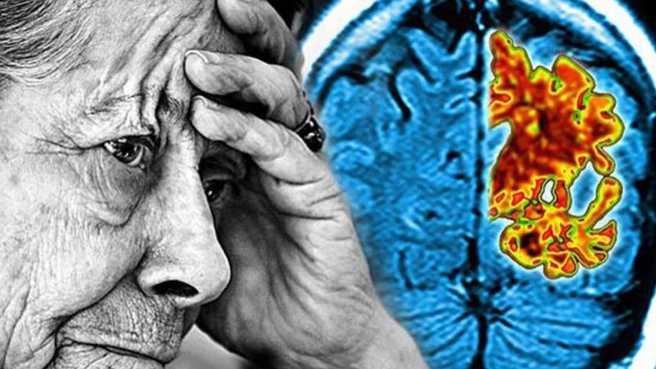 Yeni bir araştırmayla ortaya çıktı! Bu takviye alzheimer riskini azaltıyor