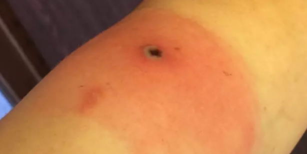 Yeni kabus: Alaskapox virüsü! Yetkililer ilk ölümün gerçekleştiğini duyurdu!