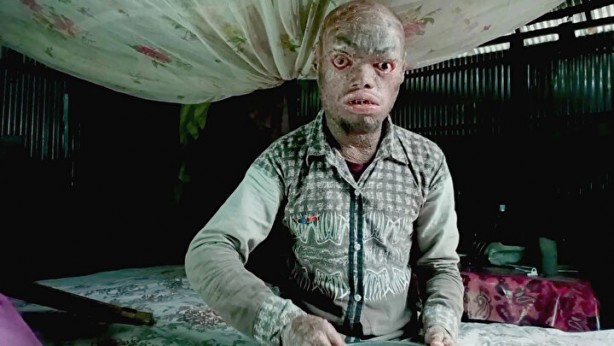 Foto - "yılan adam" Her hafta deri değiştiriyor