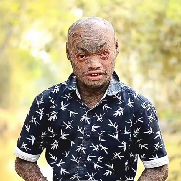 Foto - "yılan adam" Her hafta deri değiştiriyor