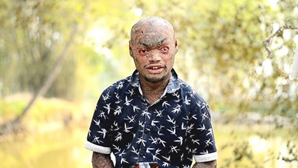 "yılan adam" Her hafta deri değiştiriyor