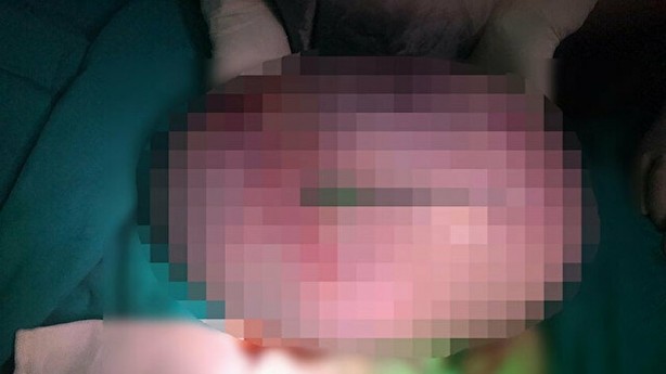 Foto - Yıllardır 'göbeğim var' sanıyordu! Doktora gidince acı gerçeği öğrendi