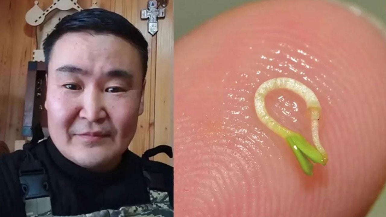 Foto - Yok böyle tıp vakası: Gözünden çıkan şey doktorları bile şoke etti