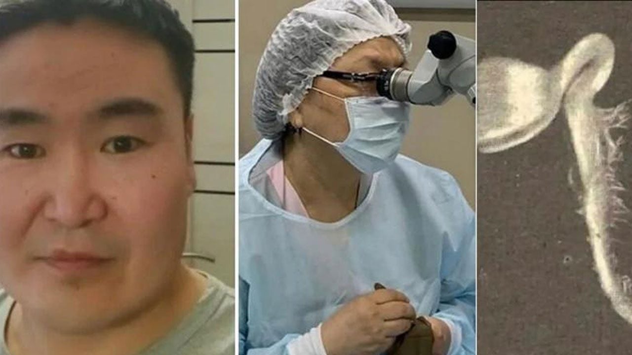 Yok böyle tıp vakası: Gözünden çıkan şey doktorları bile şoke etti