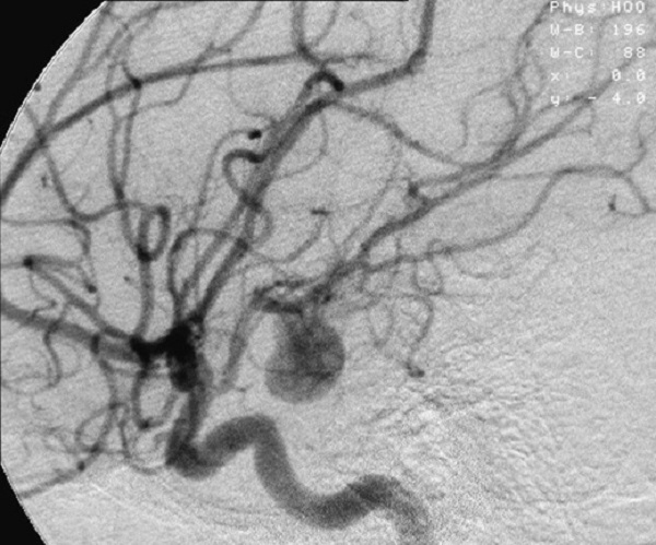 Foto - Yüksek tansiyon hastalarının korkulu rüyası! Bu belirtiler varsa hiç beklemeyin