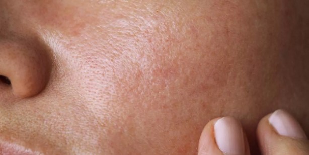 Foto - Yüz nasıl nemlendirilir? Kuru ciltlere hangi besinler iyi gelir? 