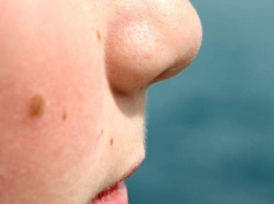 Foto - Yüzdeki benler nasıl geçer? Suya atıp bir gece bekletin