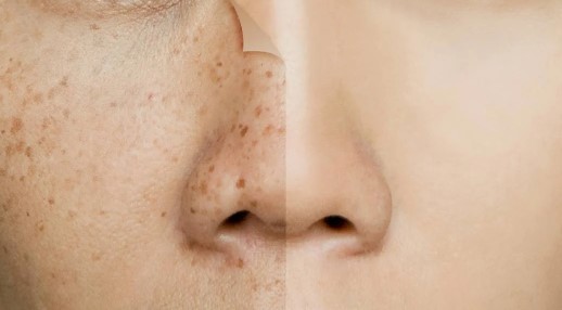 Foto - Yüzdeki çillerin sebebi nedir? Çillerden nasıl kurtuluruz?