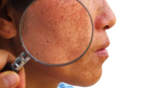 Foto - Yüzdeki çillerin sebebi nedir? Çillerden nasıl kurtuluruz?