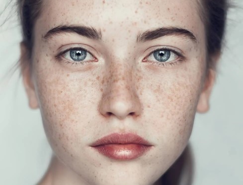 Foto - Yüzdeki çillerin sebebi nedir? Çillerden nasıl kurtuluruz?