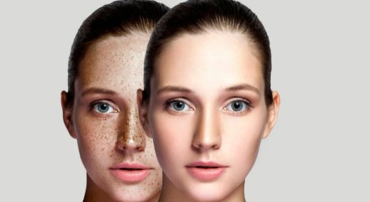 Foto - Yüzdeki çillerin sebebi nedir? Çillerden nasıl kurtuluruz?