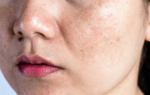 Foto - Yüzdeki çillerin sebebi nedir? Çillerden nasıl kurtuluruz?