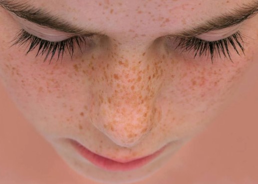 Foto - Yüzdeki çillerin sebebi nedir? Çillerden nasıl kurtuluruz?