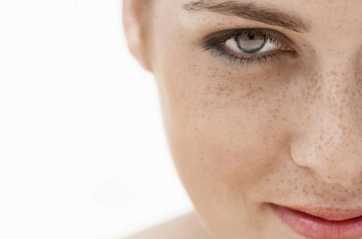 Foto - Yüzdeki çillerin sebebi nedir? Çillerden nasıl kurtuluruz?