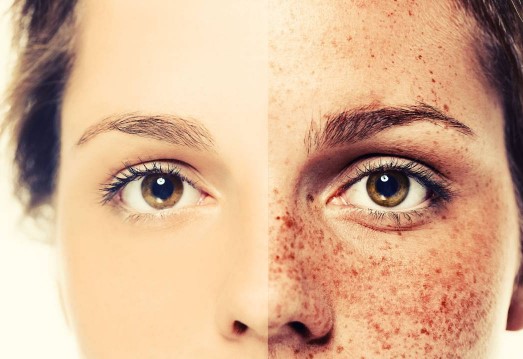 Foto - Yüzdeki çillerin sebebi nedir? Çillerden nasıl kurtuluruz?