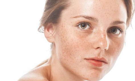 Foto - Yüzdeki çillerin sebebi nedir? Çillerden nasıl kurtuluruz?