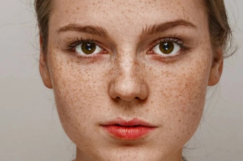 Foto - Yüzdeki çillerin sebebi nedir? Çillerden nasıl kurtuluruz?