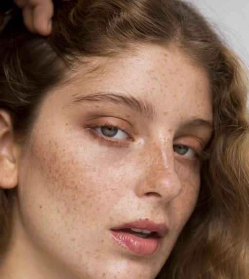 Foto - Yüzdeki çillerin sebebi nedir? Çillerden nasıl kurtuluruz?