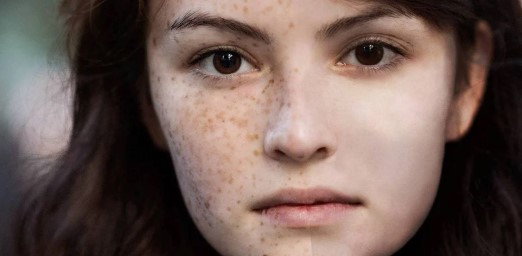 Foto - Yüzdeki çillerin sebebi nedir? Çillerden nasıl kurtuluruz?