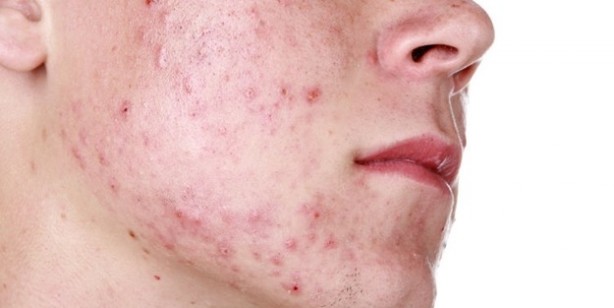 Foto - Yüzdeki o sivilcelere dikkat! Hastalığın habercisi olabilir...