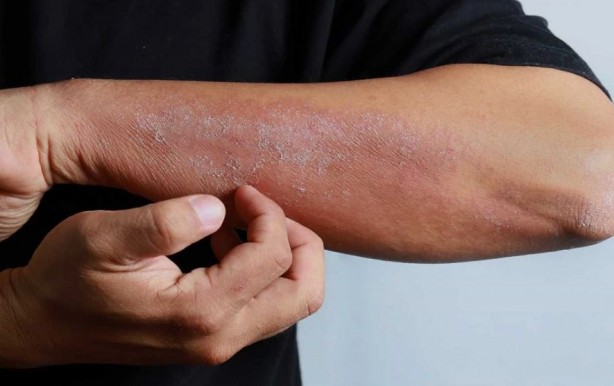 Yüzdeki o sivilcelere dikkat! Hastalığın habercisi olabilir...