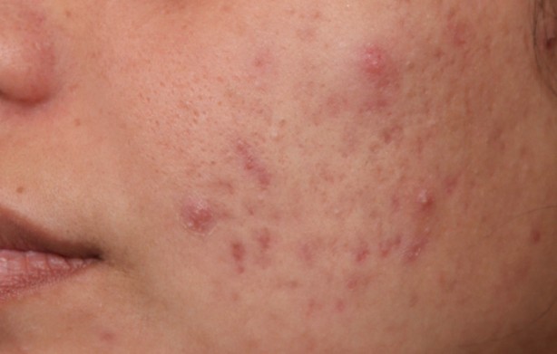 Foto - Yüzdeki o sivilcelere dikkat! Hastalığın habercisi olabilir...