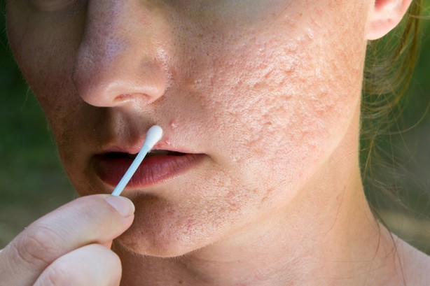 Foto - Yüzdeki o sivilcelere dikkat! Hastalığın habercisi olabilir...