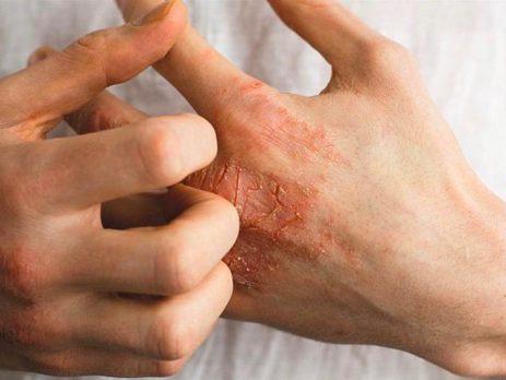 Foto - Yüzdeki o sivilcelere dikkat! Hastalığın habercisi olabilir...