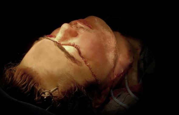 Foto - Yüzü parçalanan adamın inanılmaz değişimi