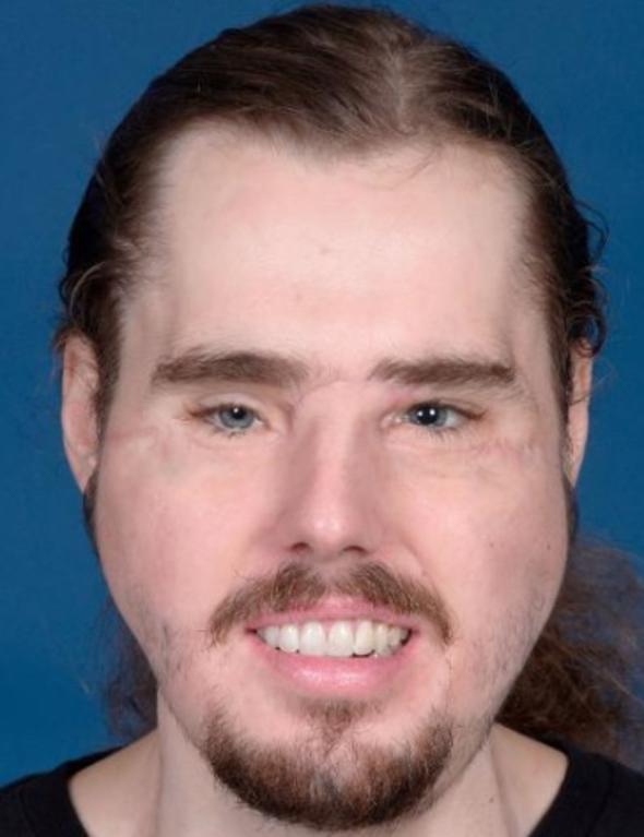 Foto - Yüzü parçalanan adamın inanılmaz değişimi