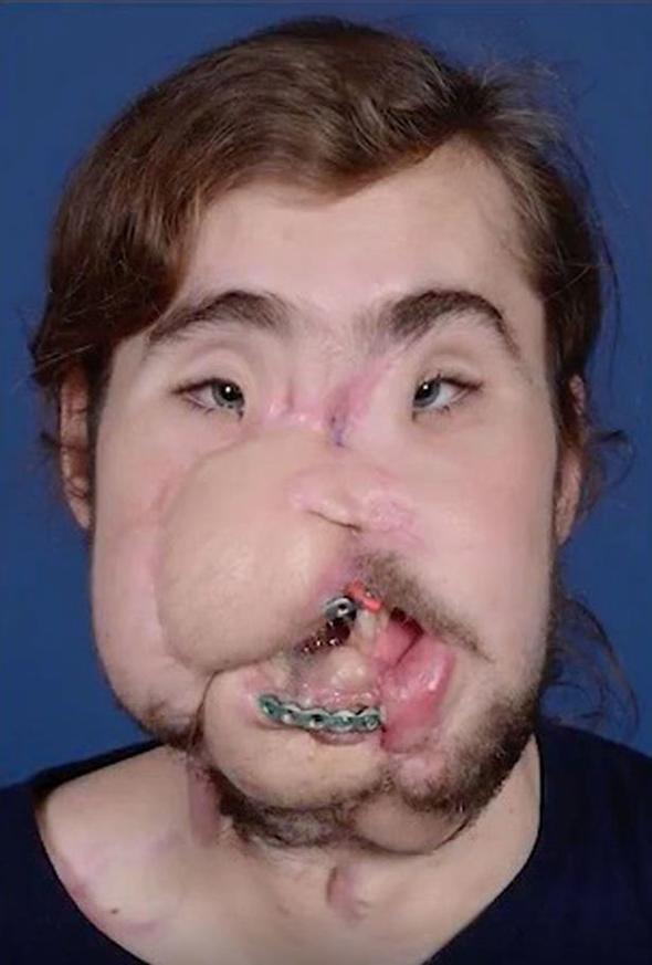 Foto - Yüzü parçalanan adamın inanılmaz değişimi