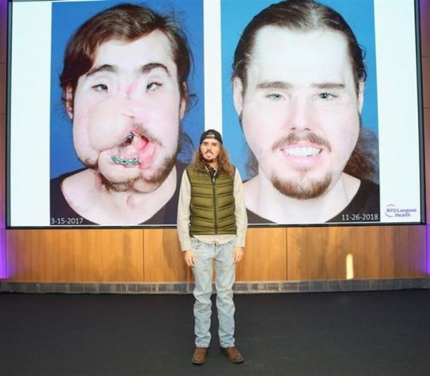 Foto - Yüzü parçalanan vatandaşın inanılmaz değişimi