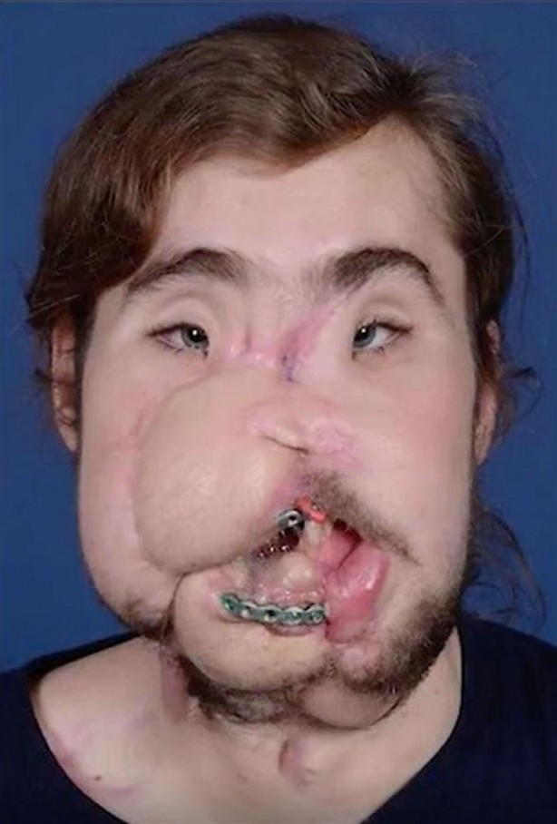 Foto - Yüzü parçalanan vatandaşın inanılmaz değişimi