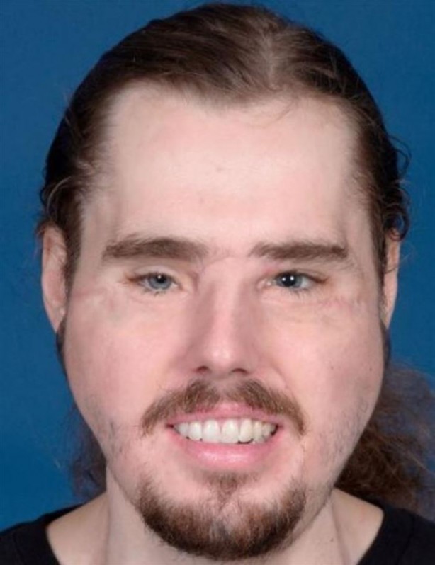 Foto - Yüzü parçalanan vatandaşın inanılmaz değişimi