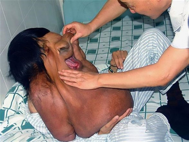 Yüzünde 15 kiloluk tümörle yaşıyor