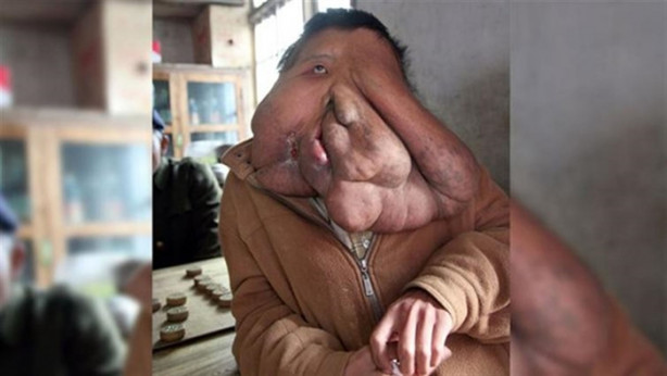 Foto - Yüzünde 15 kiloluk tümörle yaşıyor