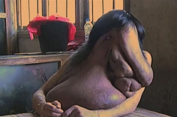 Foto - Yüzünde 15 kiloluk tümörle yaşıyor