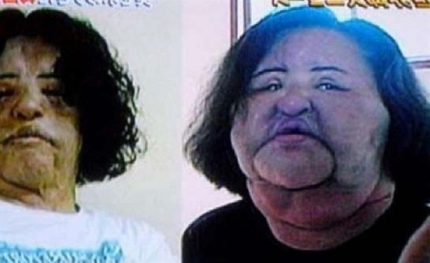 Foto - Yüzüne yemeklik yağ enjekte etti