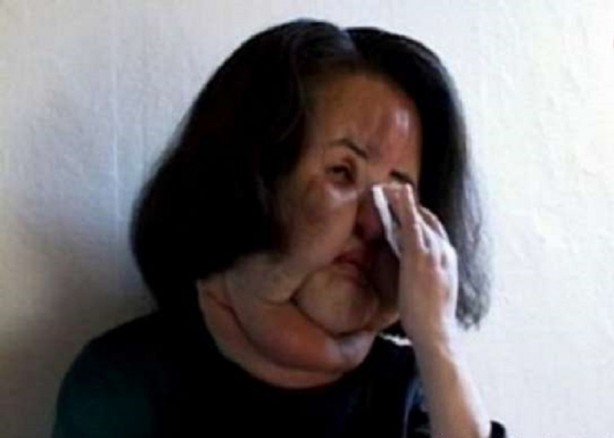 Foto - Yüzüne yemeklik yağ enjekte etti